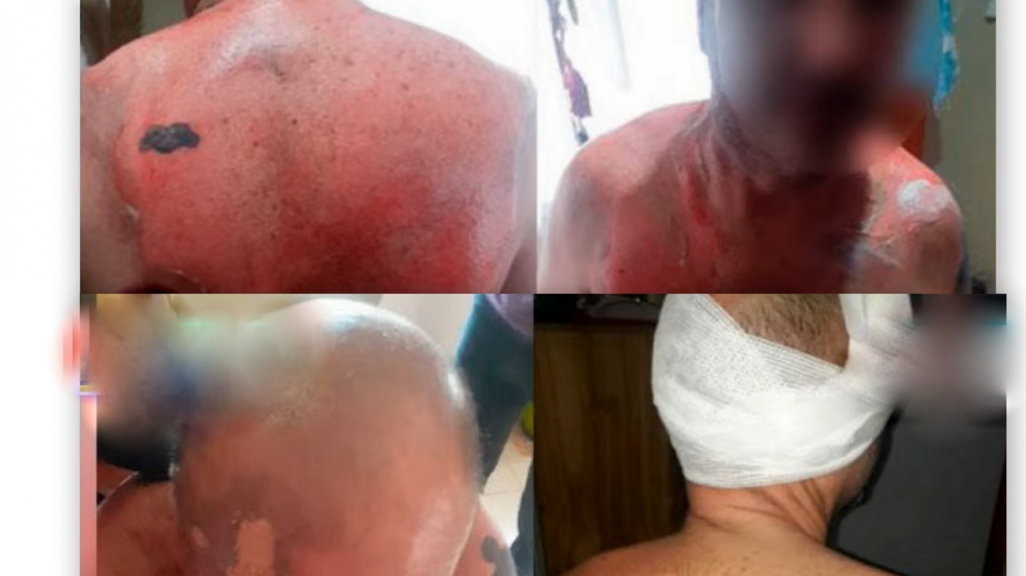 La ex mujer lo quemó con agua hirviendo porque quiso terminar la relación