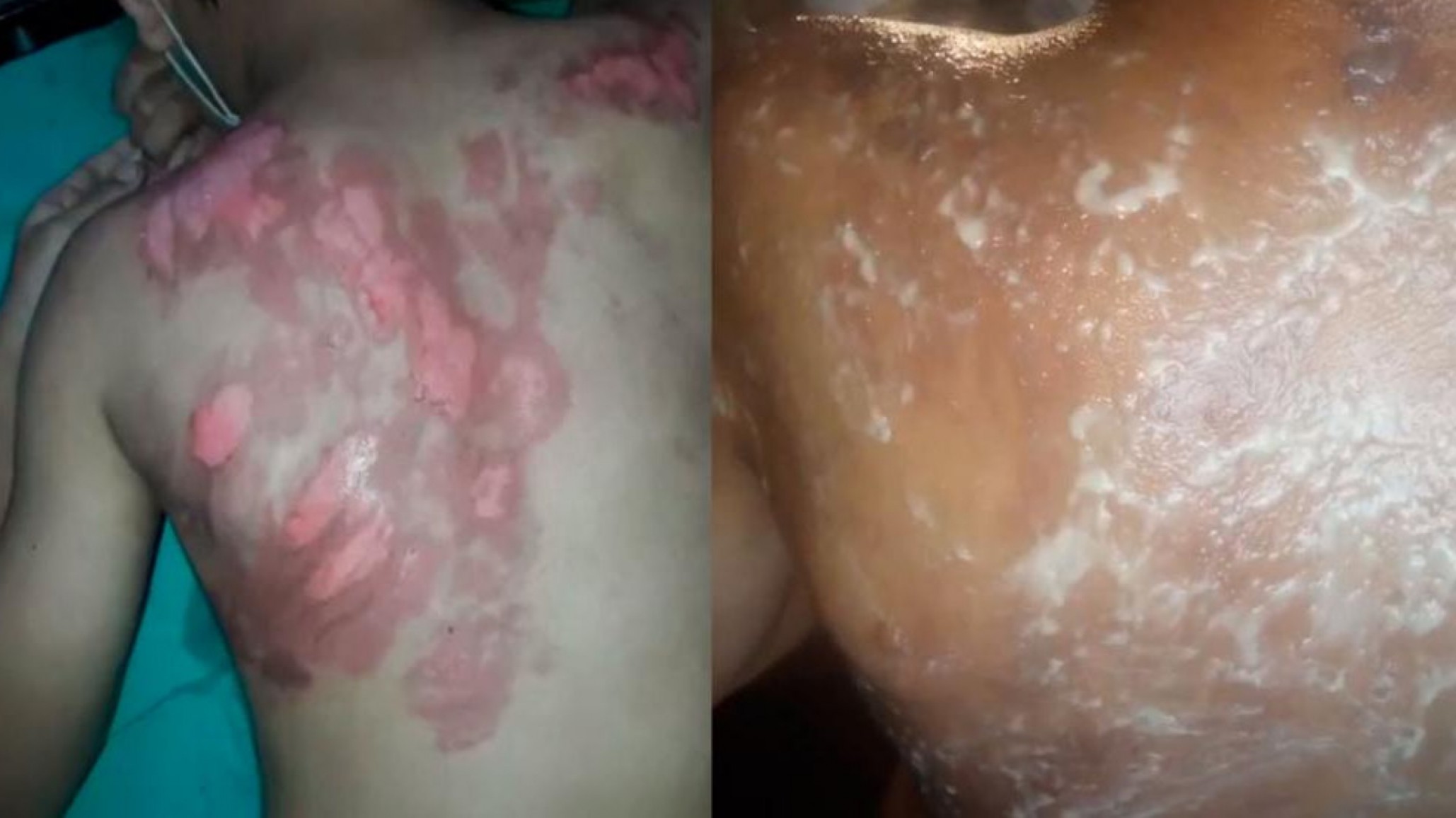 Vecina quemó a niño de 7 años “tiró agua hirviendo por la ventana”