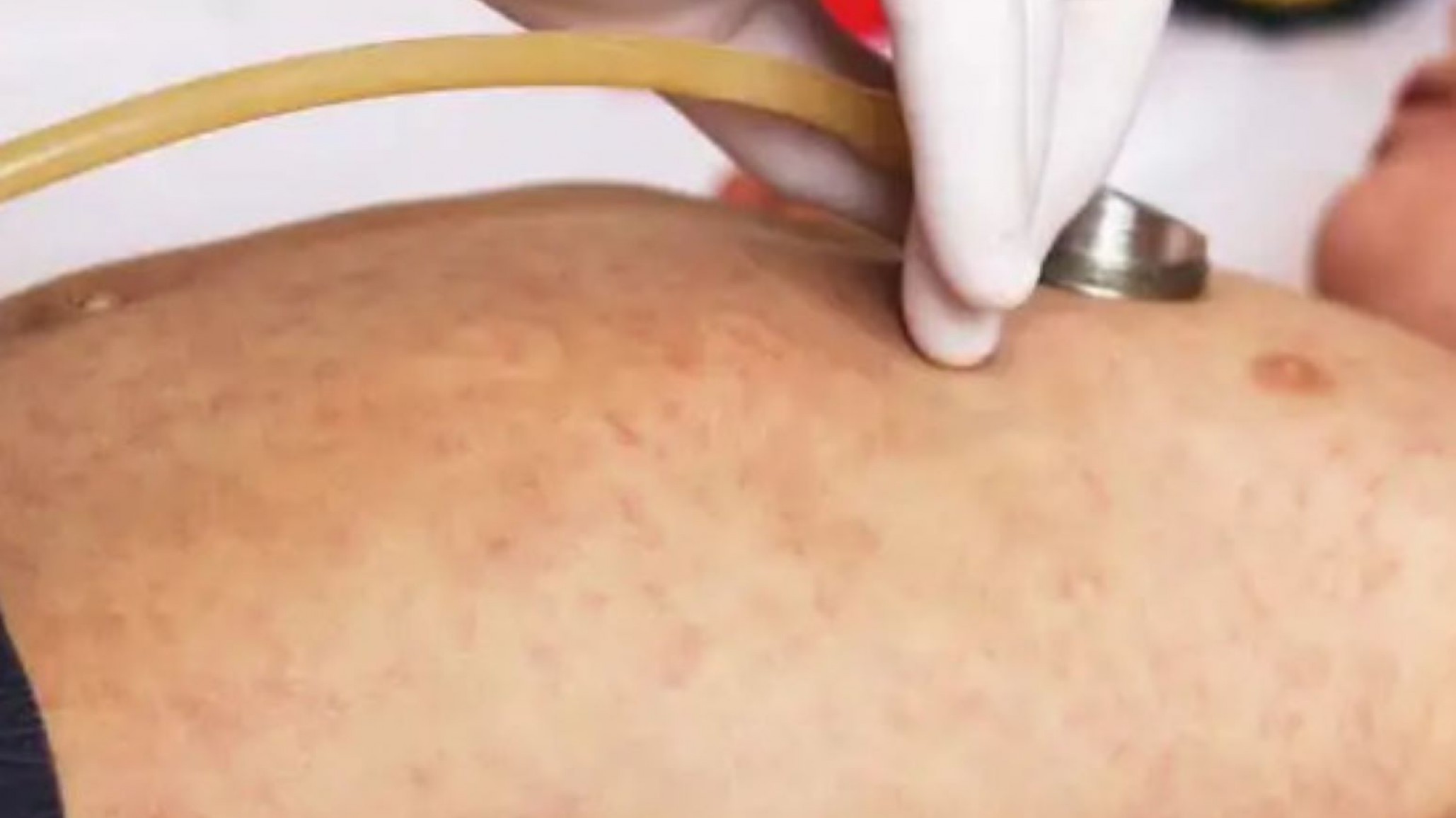 Alerta: Hay un posible caso de sarampión en la Ciudad de Buenos Aires