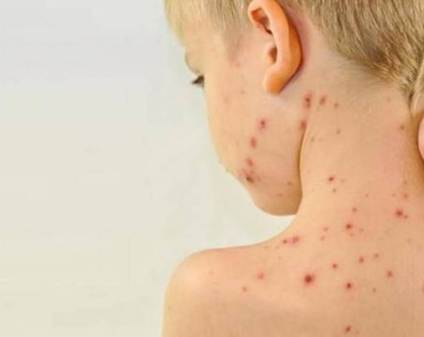 Alerta por un caso de sarampión en el país: más de la mitad de los niños de 1 año no está vacunado