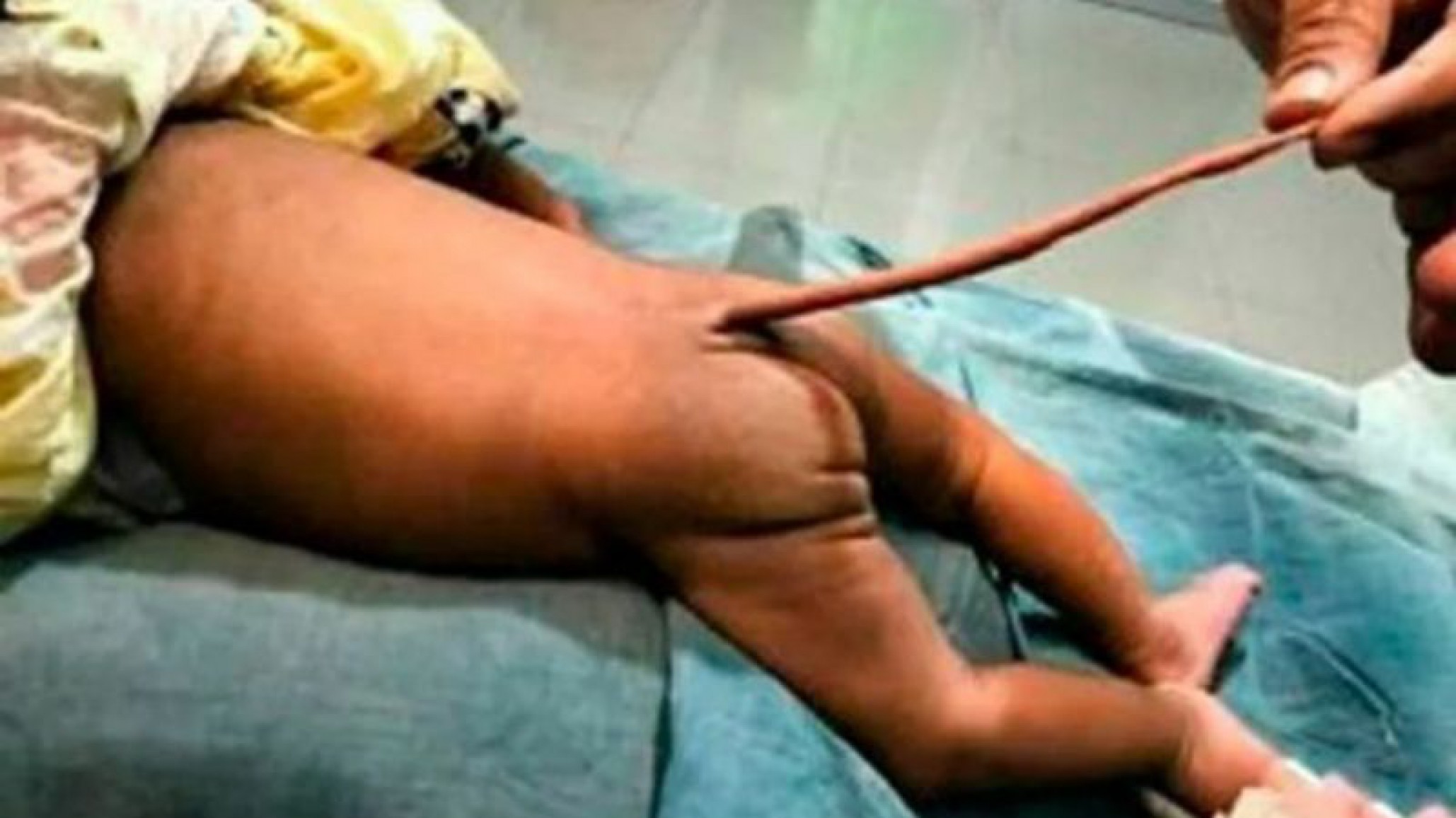 Una bebé nació con una extraña malformación y la apodaron la “niña ratón