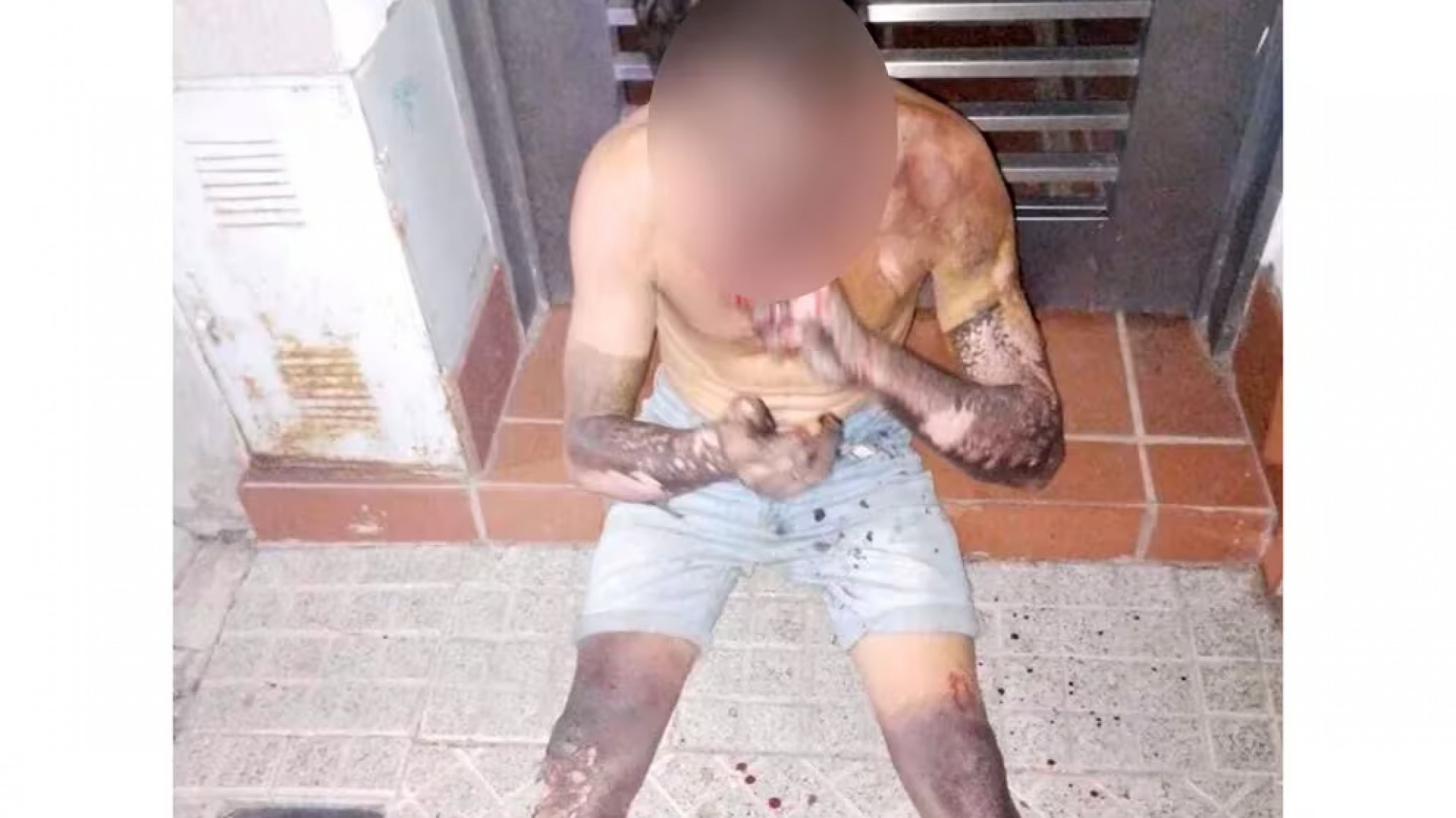 Robo de cables: un joven en estado crítico con el 80% del cuerpo quemado