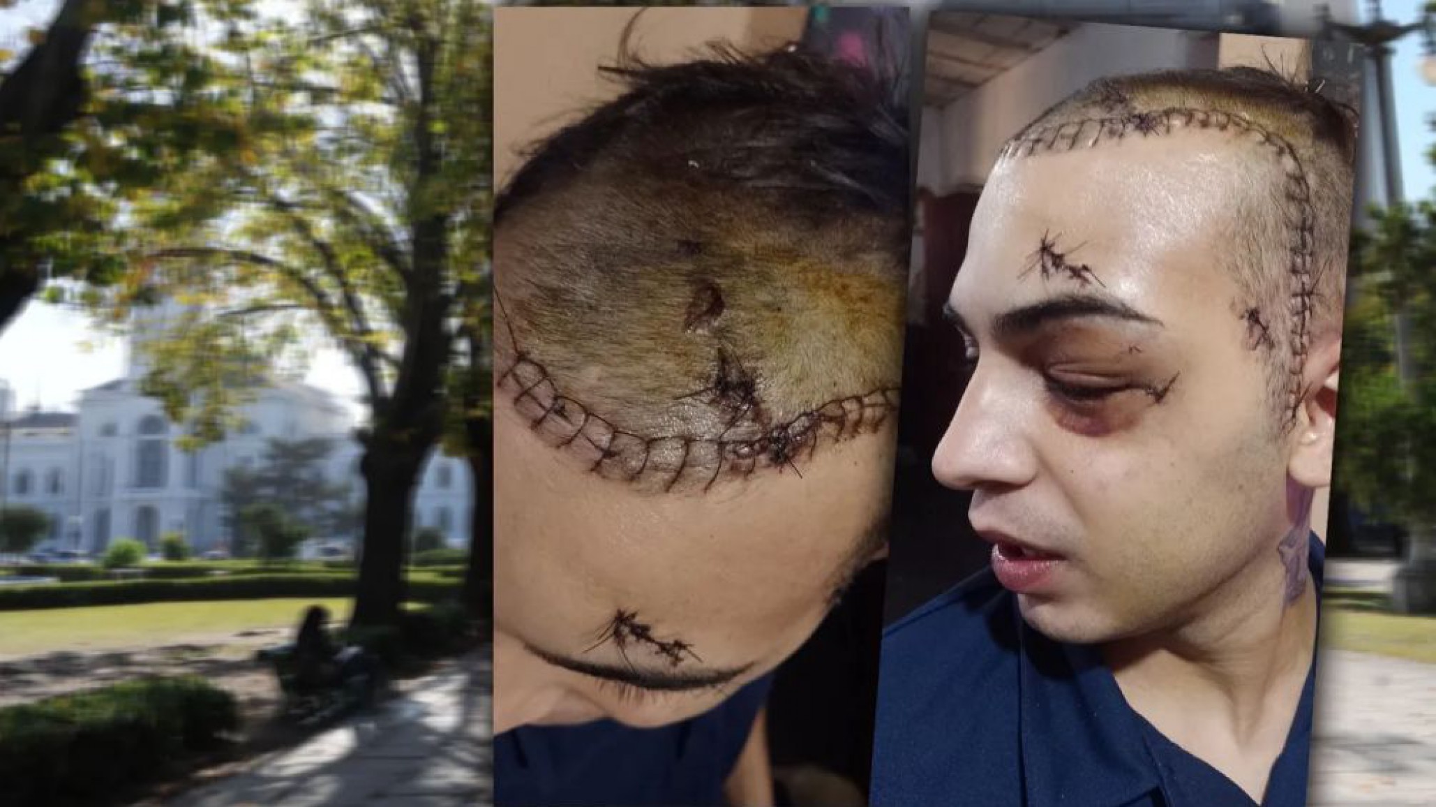 Ataque brutal: Un joven necesita una placa de titanio en el cráneo tras golpiza