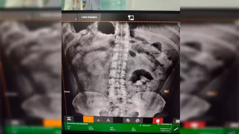 Detuvieron a dos hombres con más de 200 cápsulas de cocaína en sus estómagos