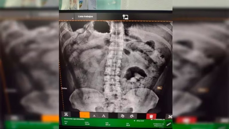 Detuvieron a dos hombres con más de 200 cápsulas de cocaína en sus estómagos