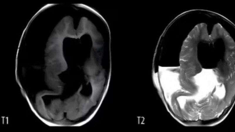 Falleció una niña que tenía un feto creciendo en su cráneo