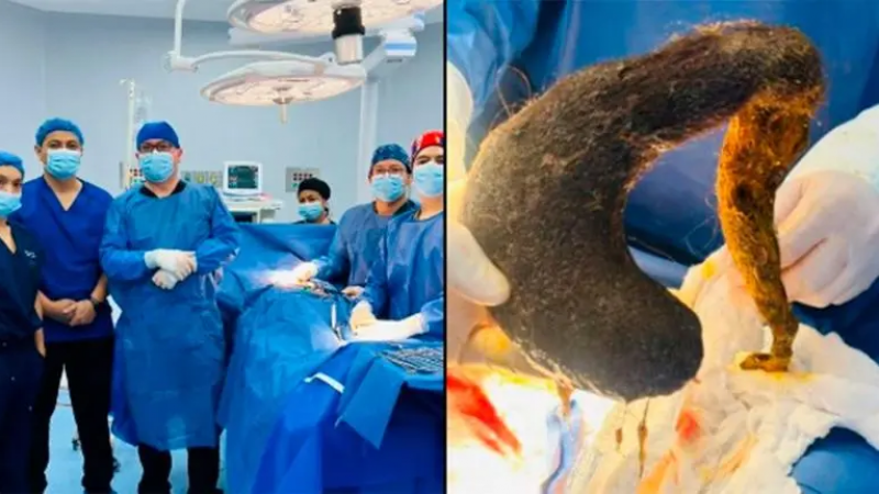 Operaron a una mujer para extraer bola de pelo gigante de su estómago