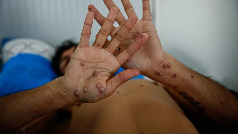 Alarma en Argentina: confirman primer caso de viruela del mono sin antecedente de viaje