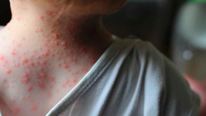 Aumenta el número de casos de viruela de mono en la Argentina