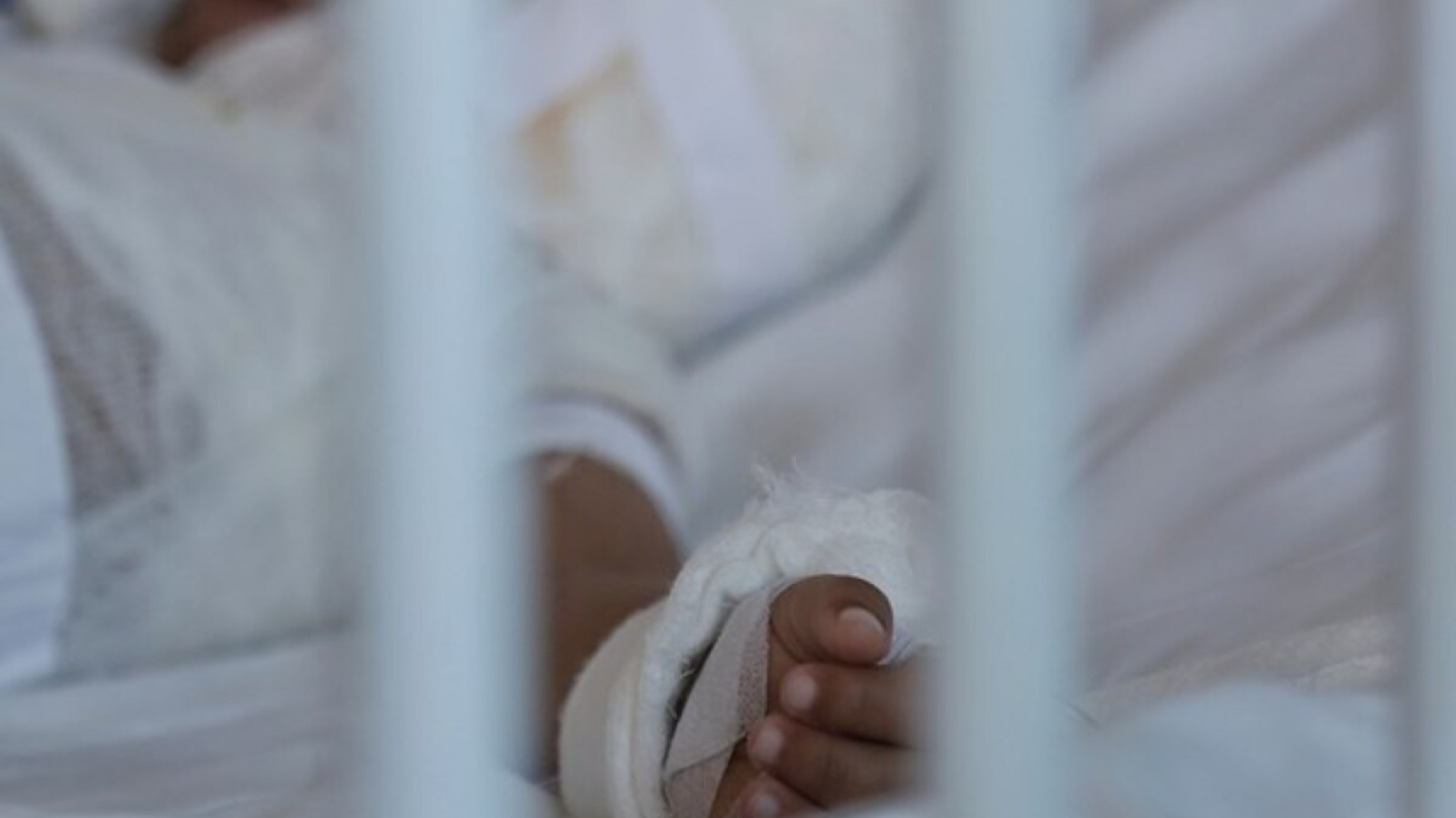 Un niño de 10 años sufrió quemaduras en un 90% de su cuerpo