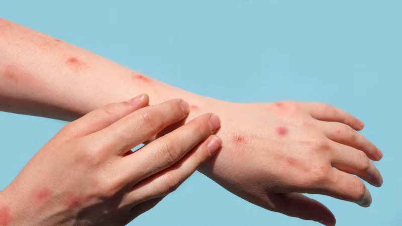 Santa Cruz confirmó dos casos de Mpox: residentes de Gobernador Gregores y El Calafate están bajo seguimiento