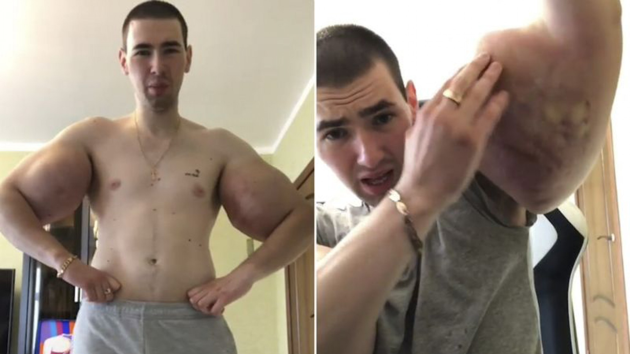 El “Popeye” ruso se opera para quitarse tres litros de relleno de los bíceps