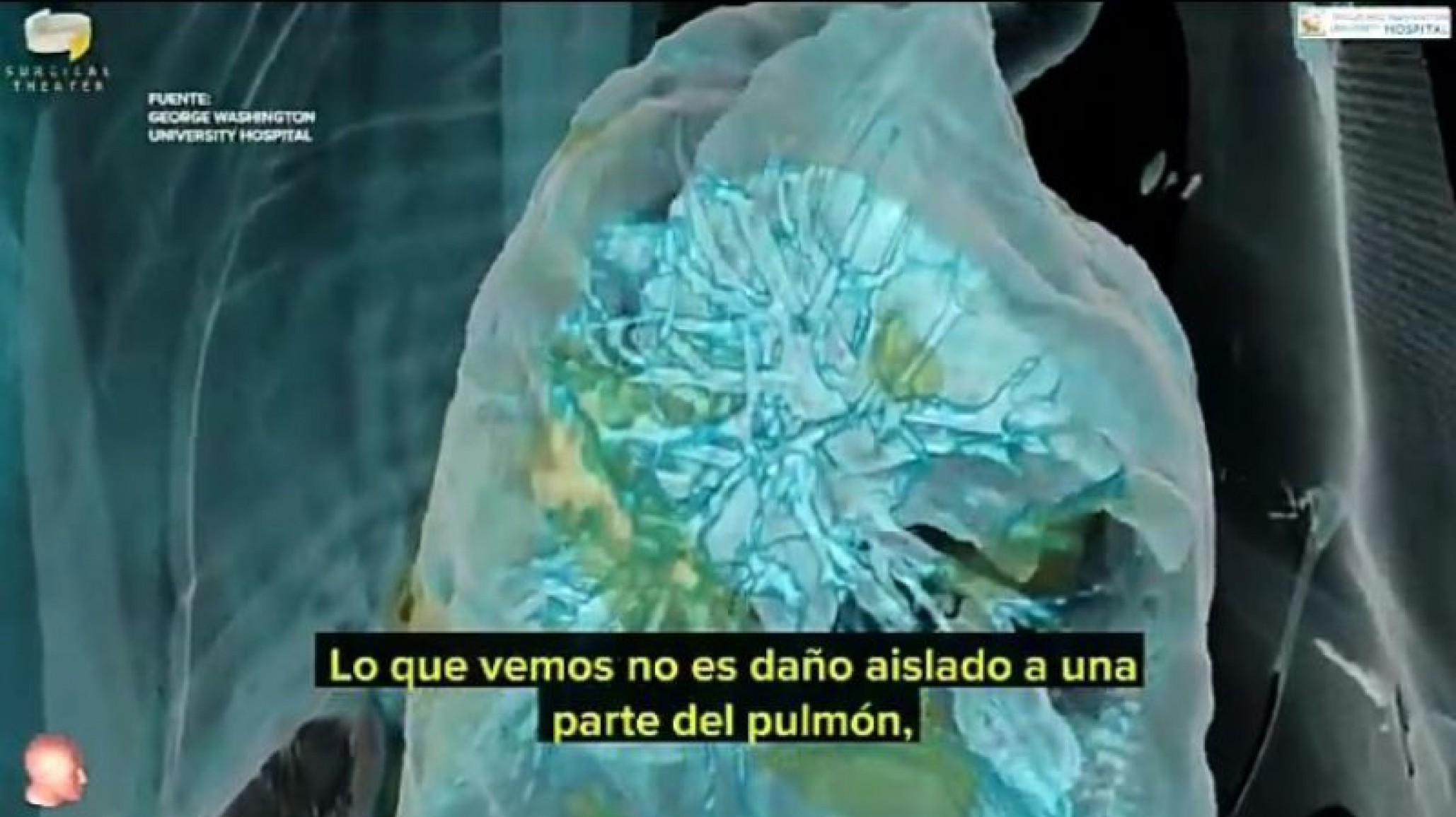Un vídeo en 3D muestra como afecta a los cuerpos infectados el Covid-19: ‘Este virus no discrimina’