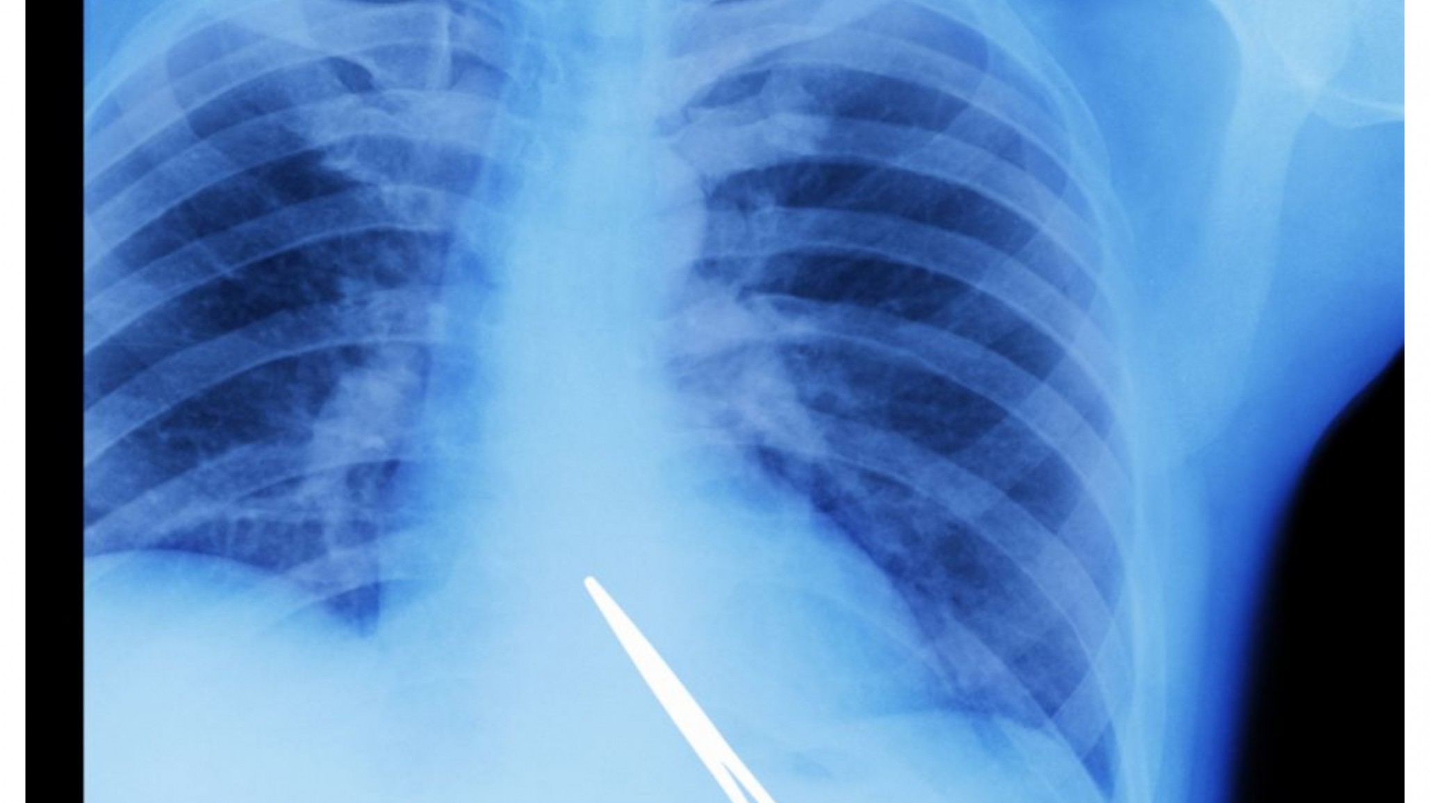 Sentía molestias, le hicieron una placa y le encontraron una tijera de una operación que se había hecho hace 5 años