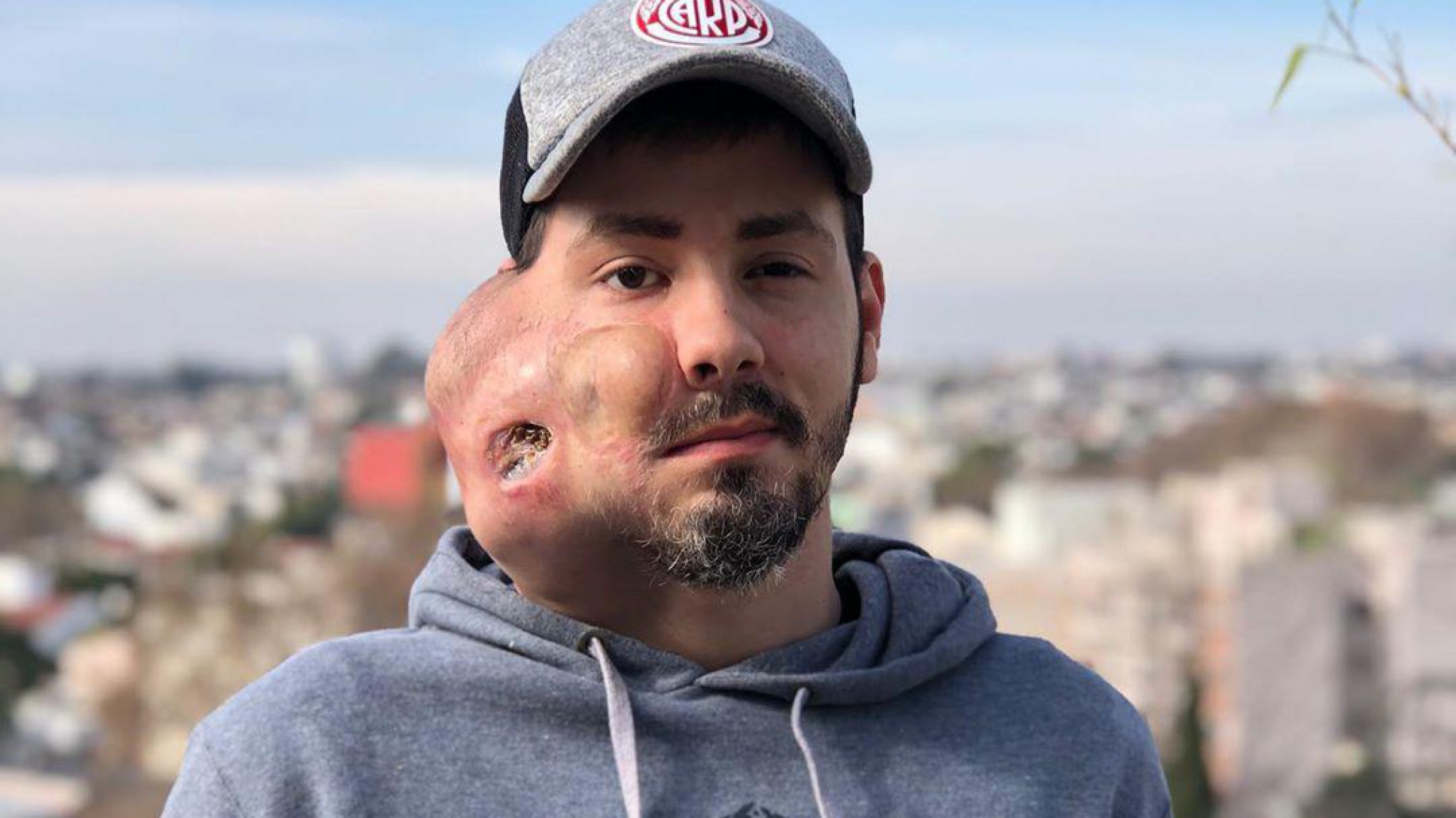 La dura lucha de Sebastián Amurin contra el cáncer: Logró conseguir ayuda de su obra social