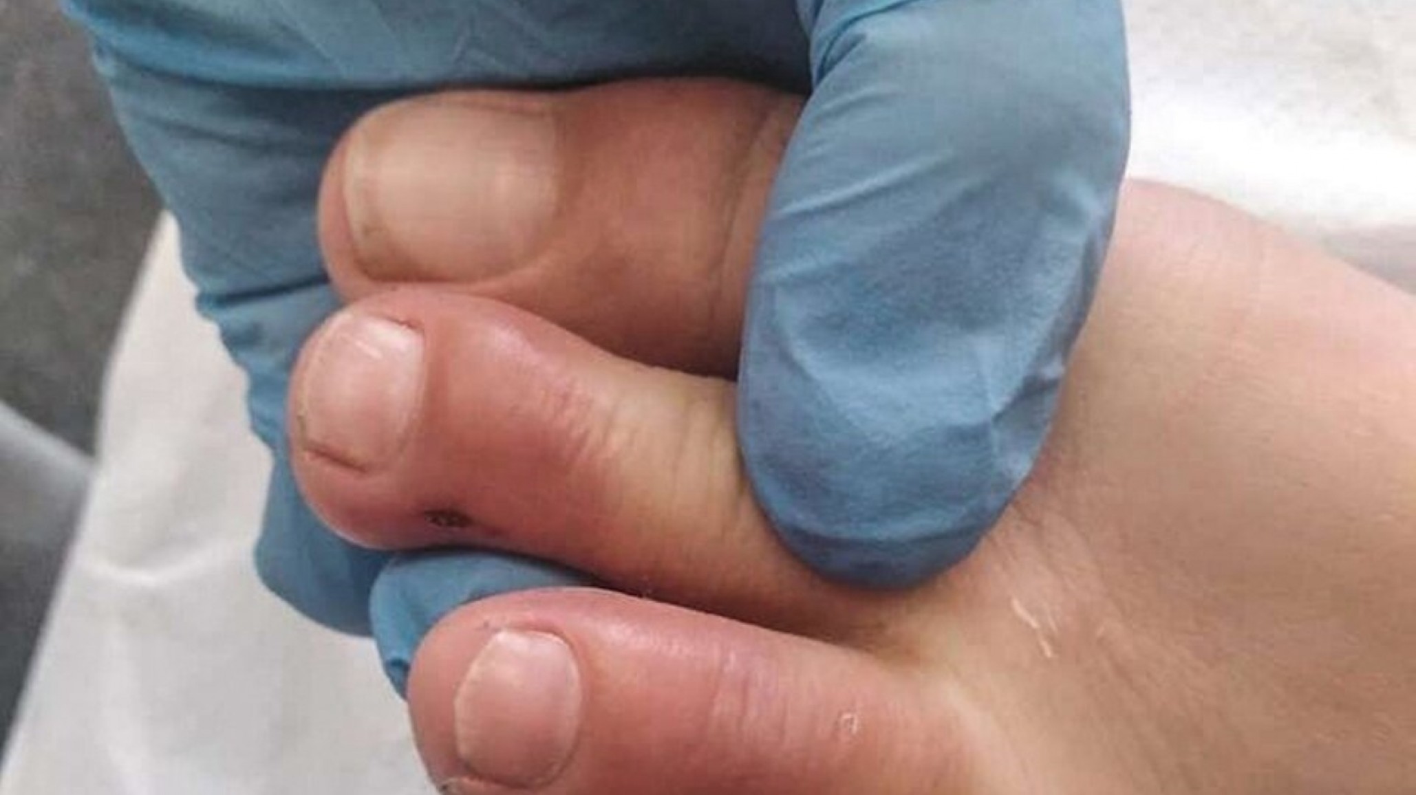 “Dedos covid”: ¿Son lesiones en pies y manos que provoca el coronavirus?