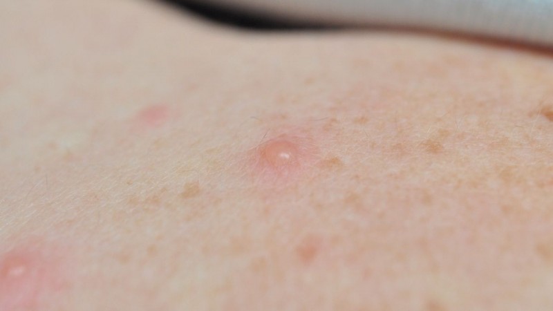 Alerta sanitaria en el país: detectaron la variante más agresiva de la viruela del mono en Argentina