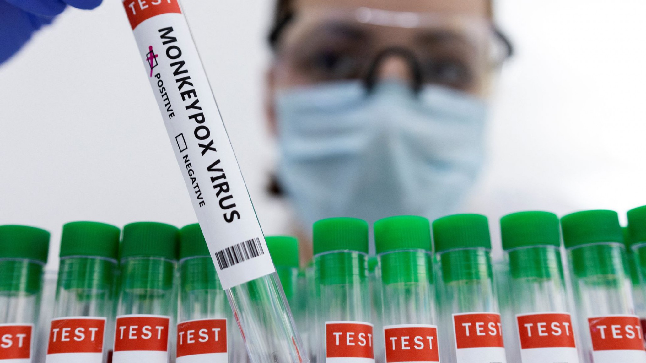 Un caso confirmado de viruela del mono no salió del país e investigan si hay transmisión local