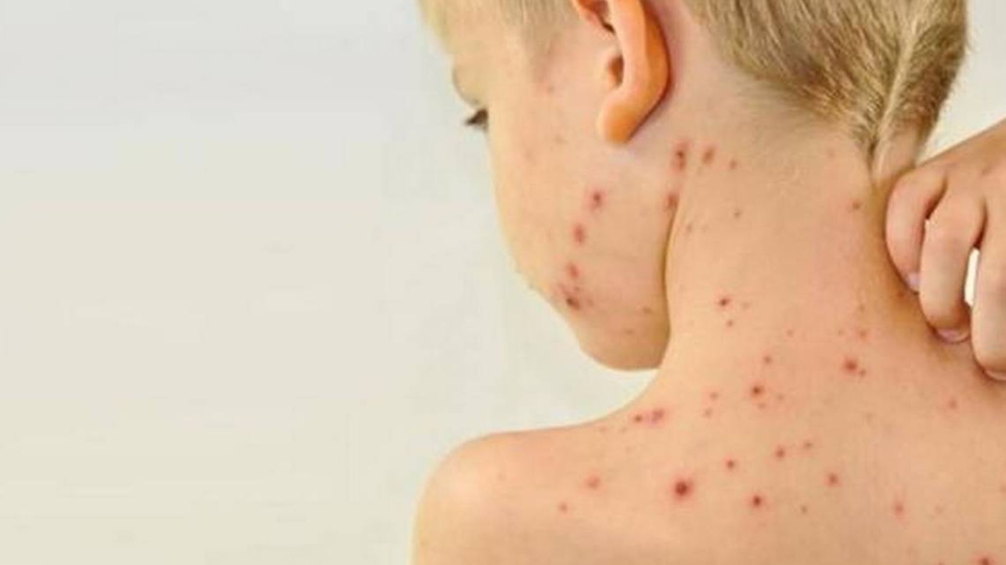 Alerta por un caso de sarampión en el país: más de la mitad de los niños de 1 año no está vacunado