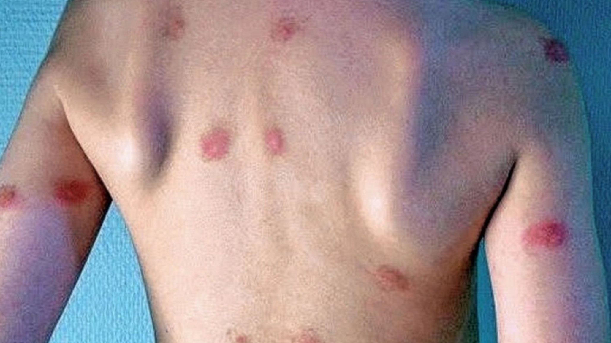 Fumigaron Escuela 23 tras denuncias de picaduras de hormigas y pulgas en alumnos