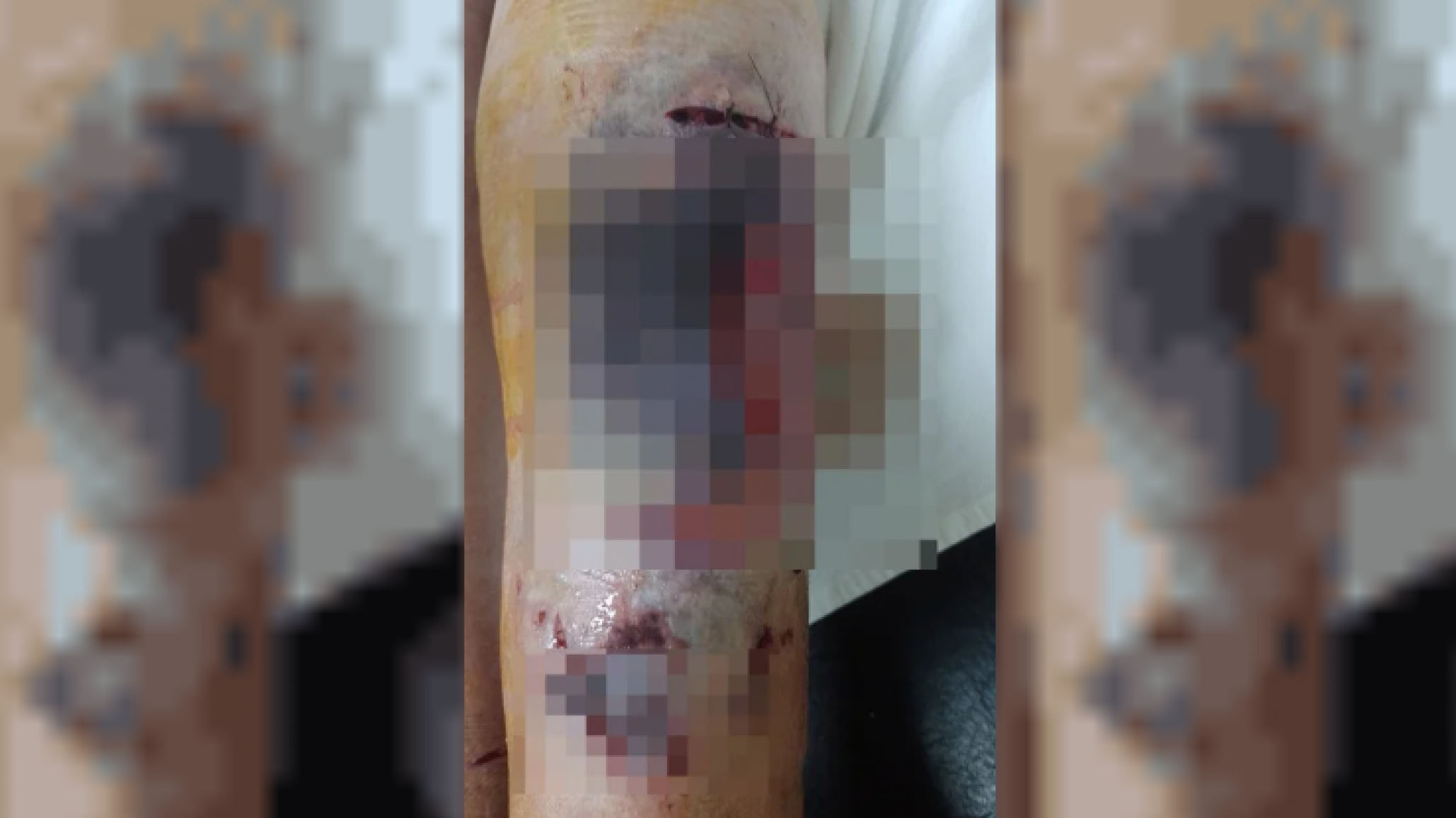 Portera de Escuela 26 con graves heridas tras ataque de dos pitbull