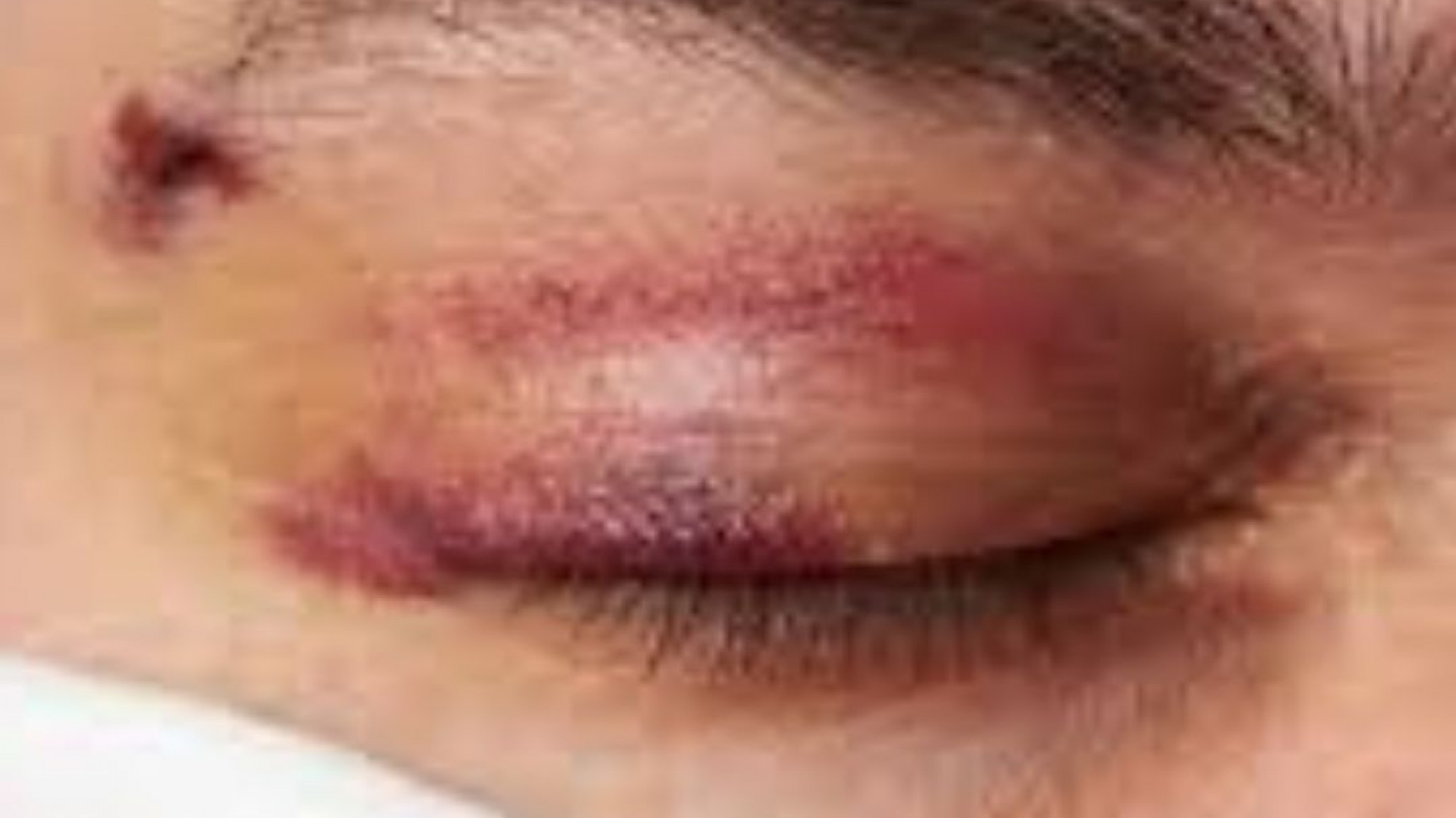 Un joven salió del boliche y le dio una patada a un policía "le dejó un derrame en el ojo"