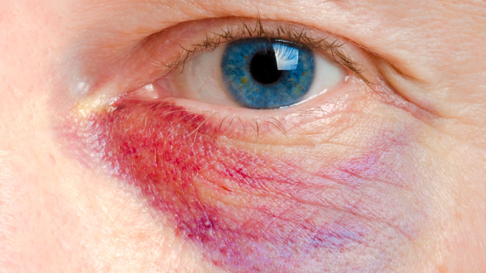 Le dio puñetazos en el ojo a una mujer y descartó un cuchillo