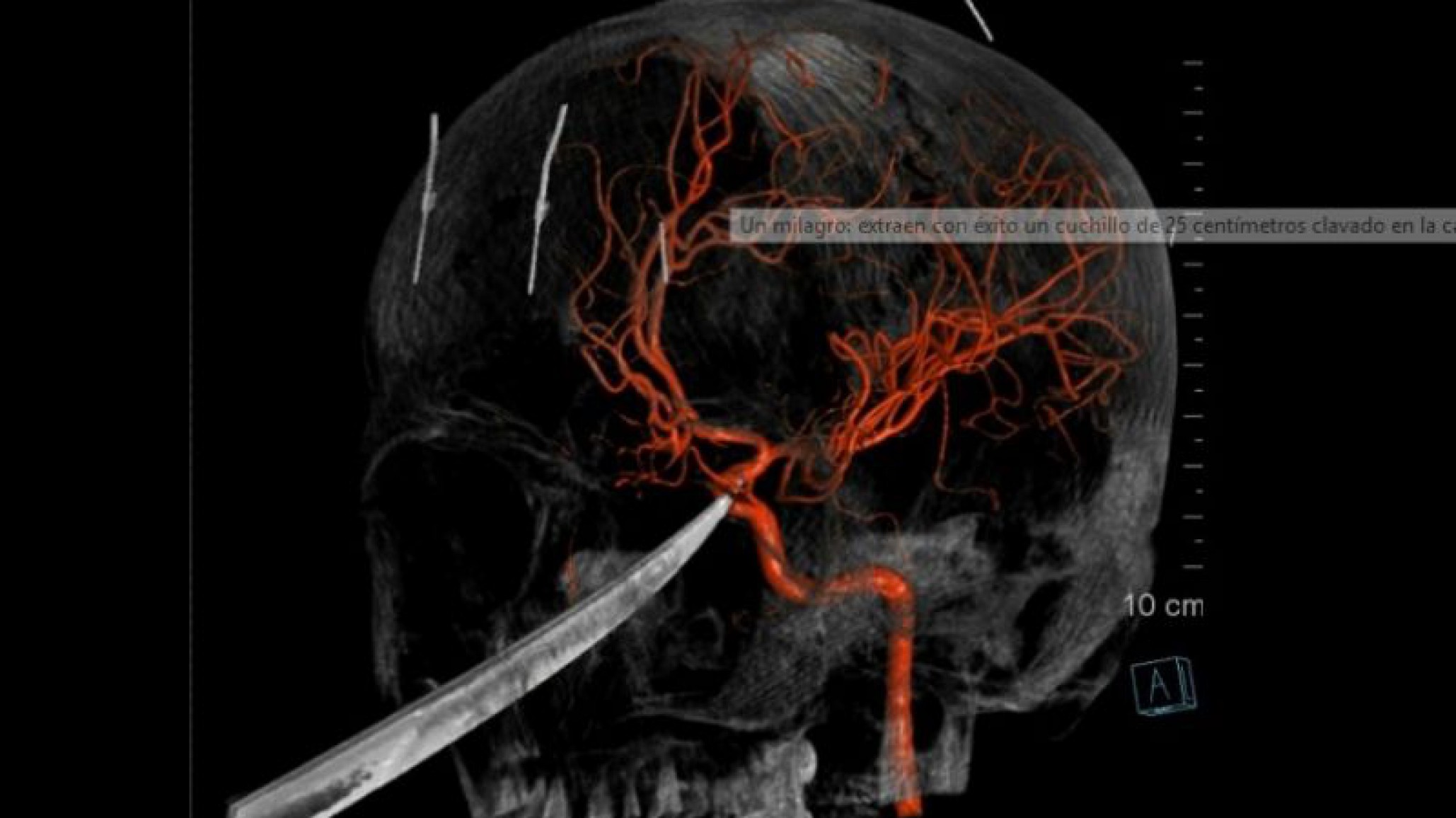 Extrajeron un cuchillo de 25 centímetros del cráneo de un adolescente