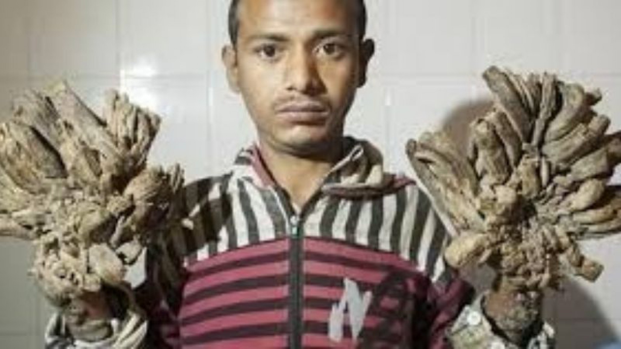 El hombre árbol tiene “nuevas ramas” y ya no soporta el dolor