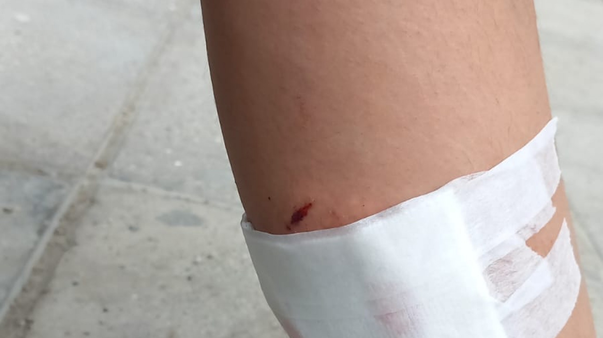 Madre de adolescente mordida por perros: "No podía mover bien la pierna y le quedaron tres heridas"