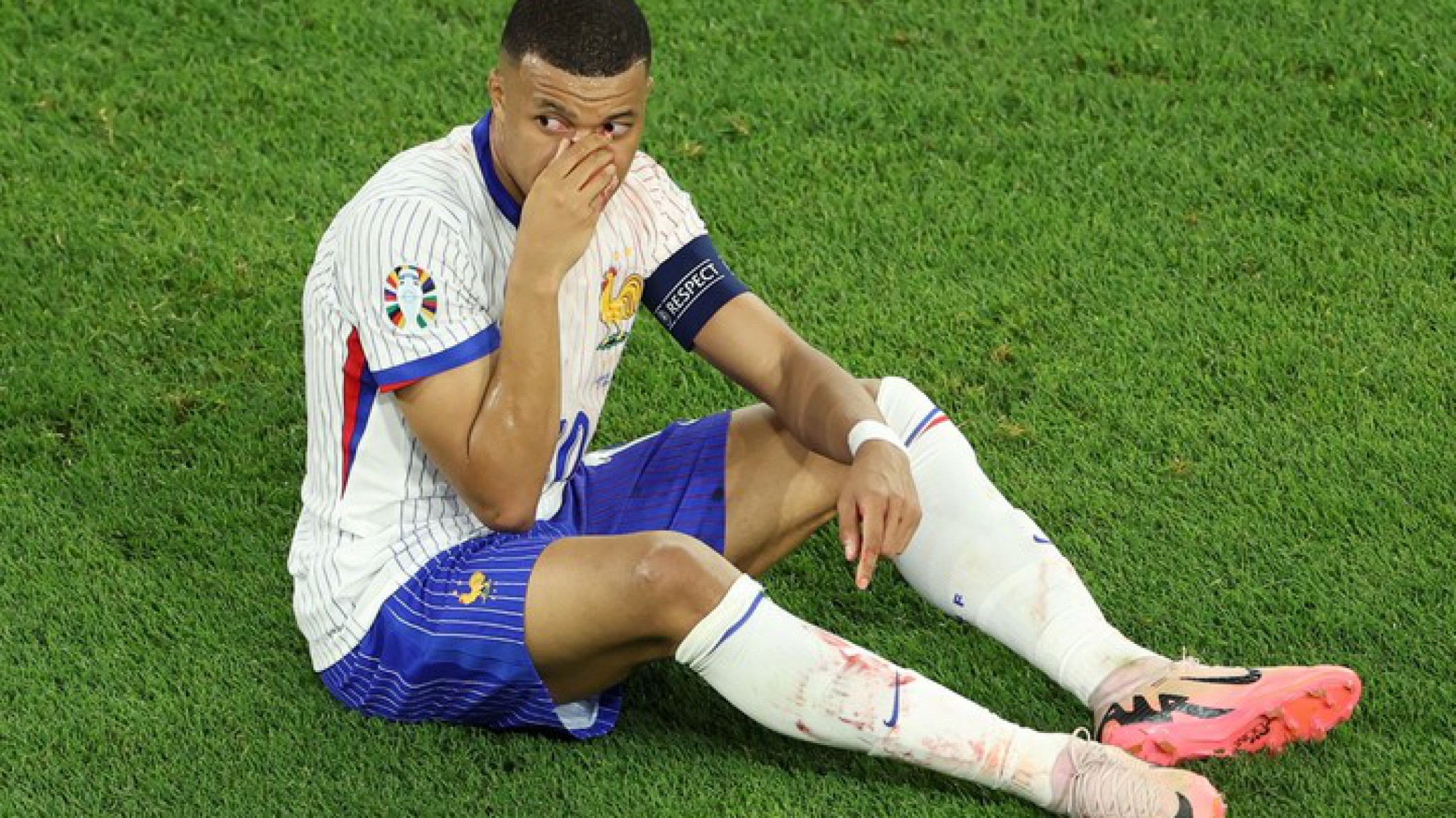 Mbappé sufrió una fractura de nariz: ¿Seguirá jugando en la Eurocopa?