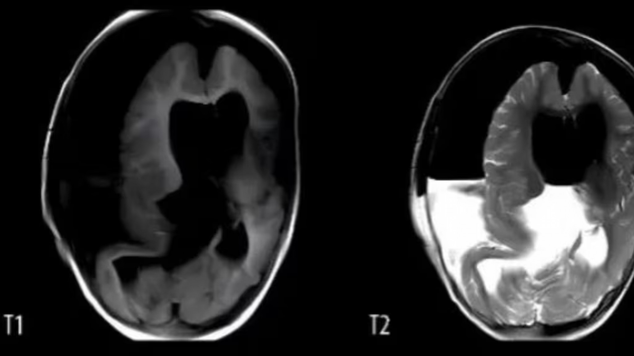 Falleció una niña que tenía un feto creciendo en su cráneo
