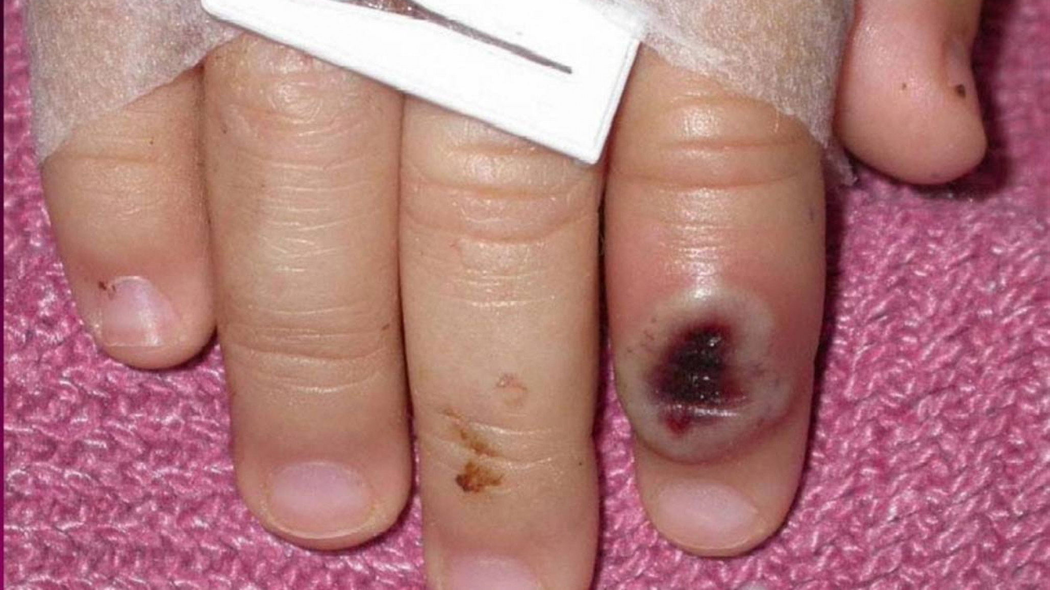 Argentina suma 8 nuevos casos de viruela del mono: ¿Cuáles son las provincias afectadas?