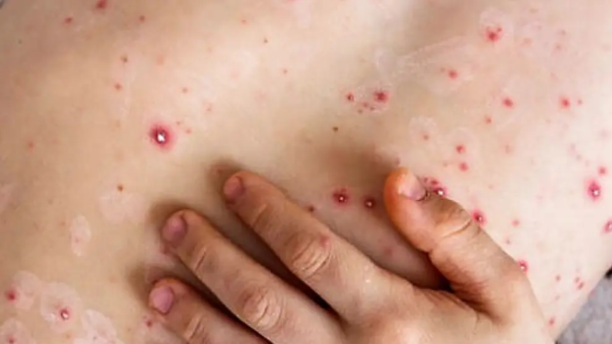 Brote de viruela símica: Argentina no escapa a la epidemia global y acumula 20 casos