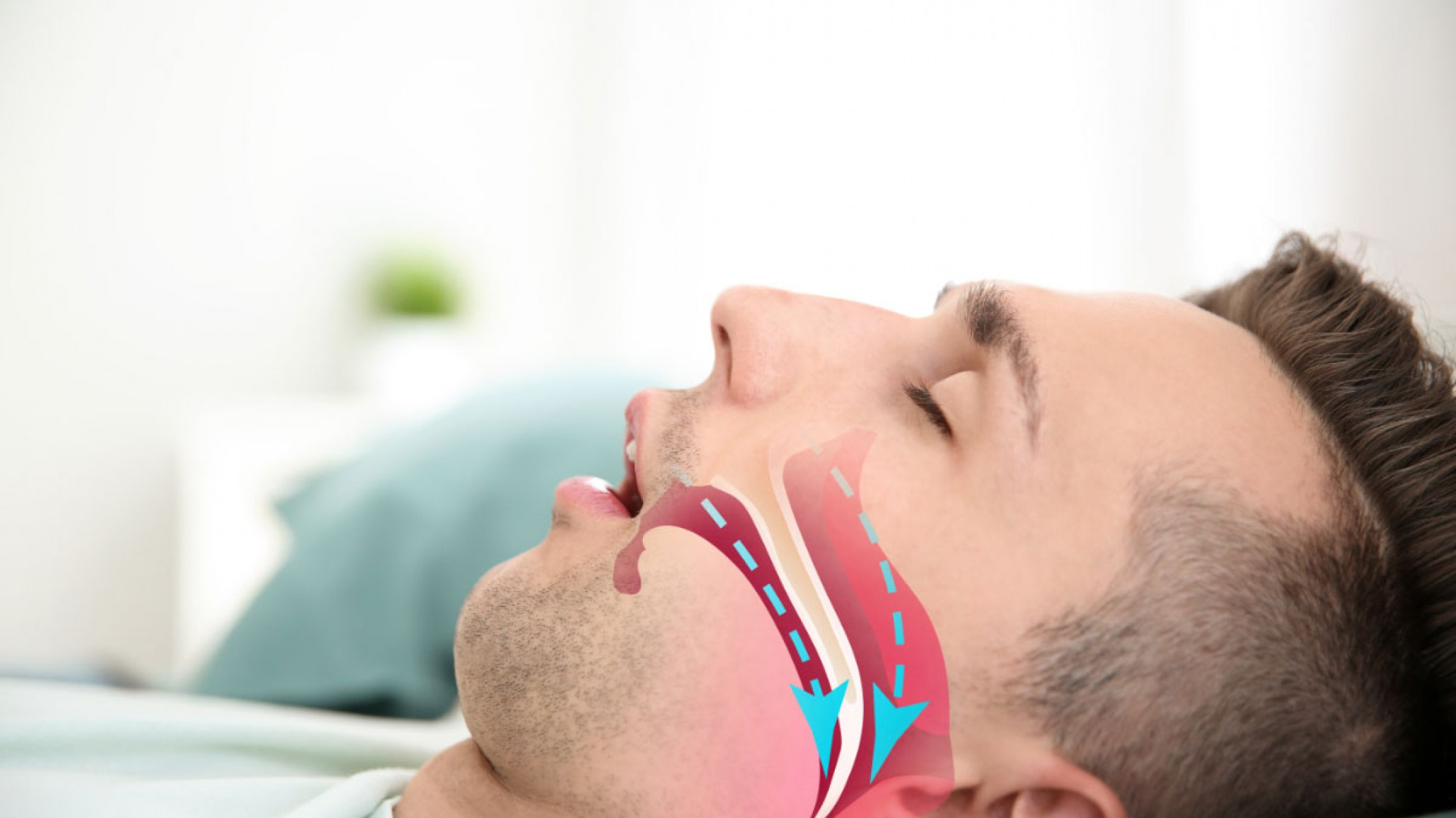 Ronquidos: un trastorno común que requiere mayor atención en Argentina