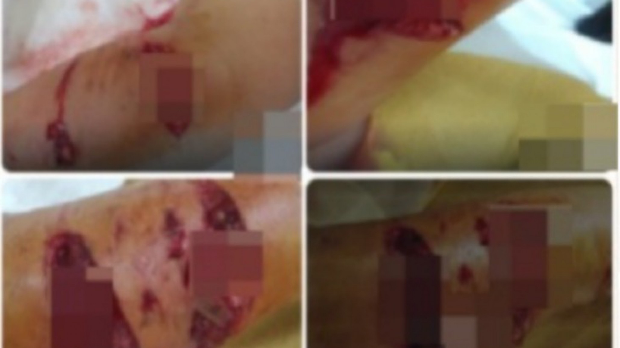 La atacó un perro brutalmente y debe costear cirugía millonaria: "Tengo los tendones destruidos y el animal sigue ahí"