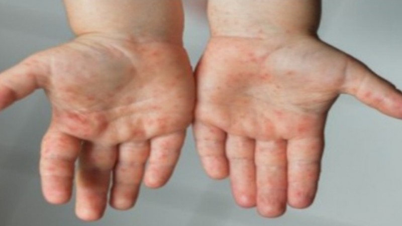 Alerta epidemiológica por sarampión en el país y brotes de varicela en Chubut: recomiendan vacunarse