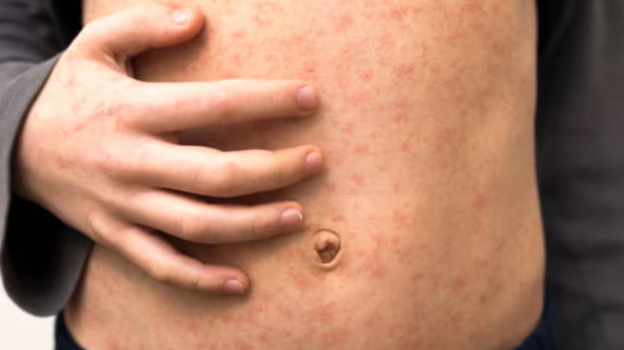 Detectaron casos de varicela en Caleta Olivia, Camarones y Madryn: alertan por baja vacunación