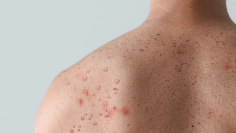 Confirmaron un caso de viruela del mono en Buenos Aires