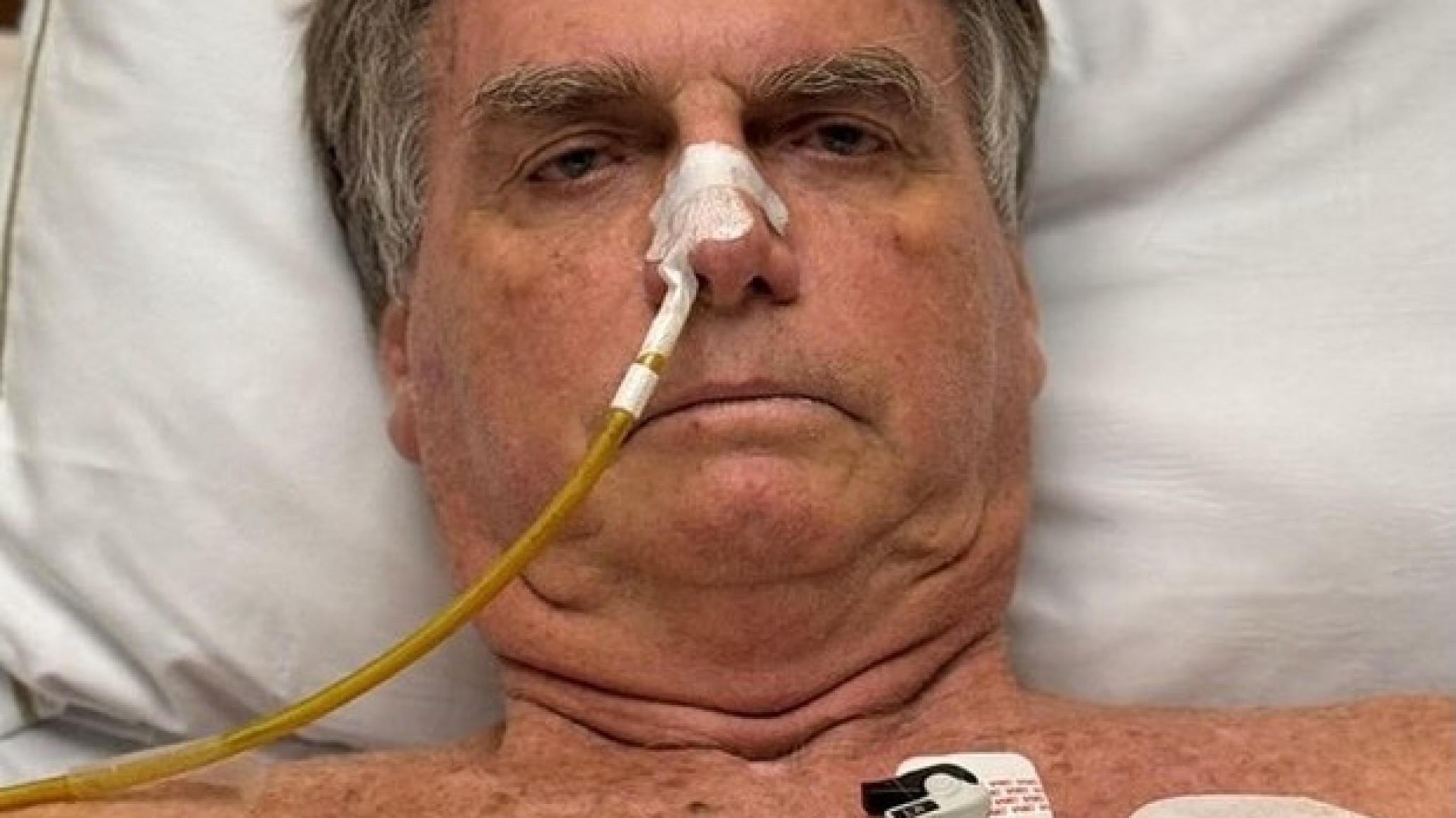 El expresidente Jair Bolsonaro fue diagnosticado con cáncer de piel