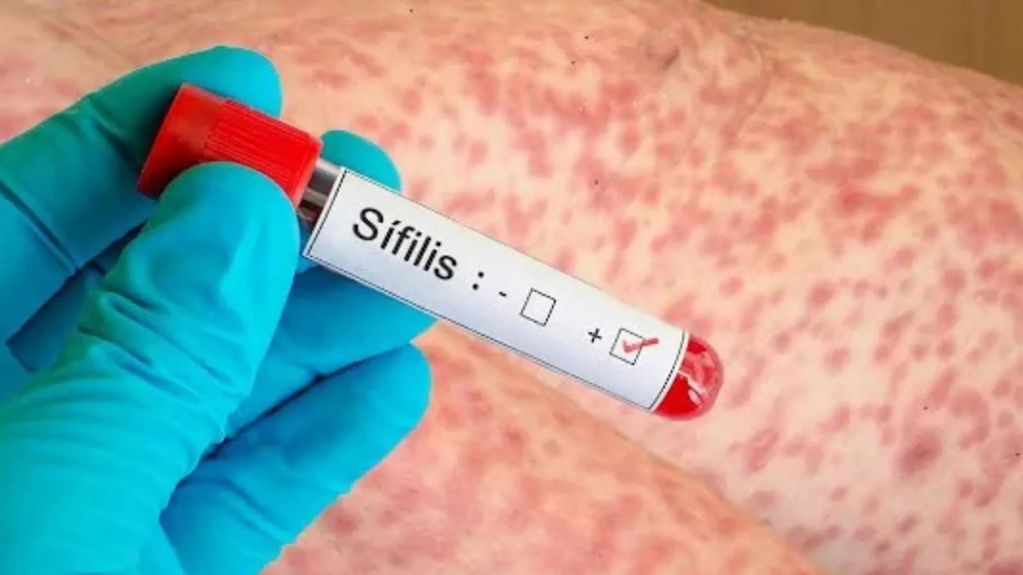 Crece la sífilis en Argentina: récord de contagios y fuerte impacto en adolescentes