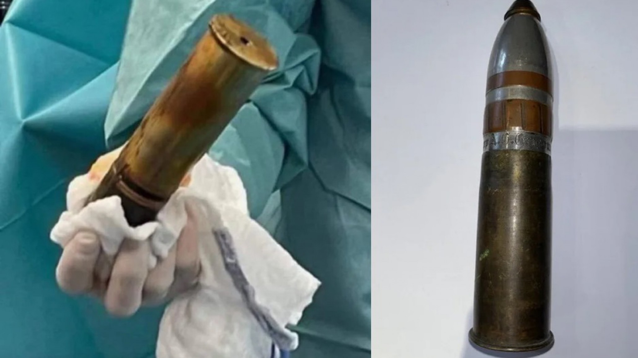 Emergencia "explosiva": un joven llegó al hospital con un proyectil de la Primera Guerra Mundial en el recto