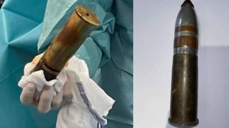 Emergencia "explosiva": un joven llegó al hospital con un proyectil de la Primera Guerra Mundial en el recto