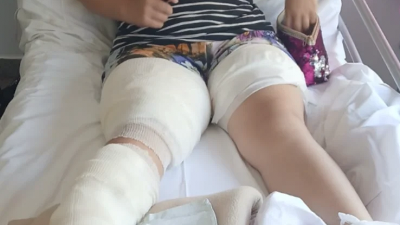 Comodoro: una niña de 12 años sufrió graves quemaduras y su familia pide ayuda