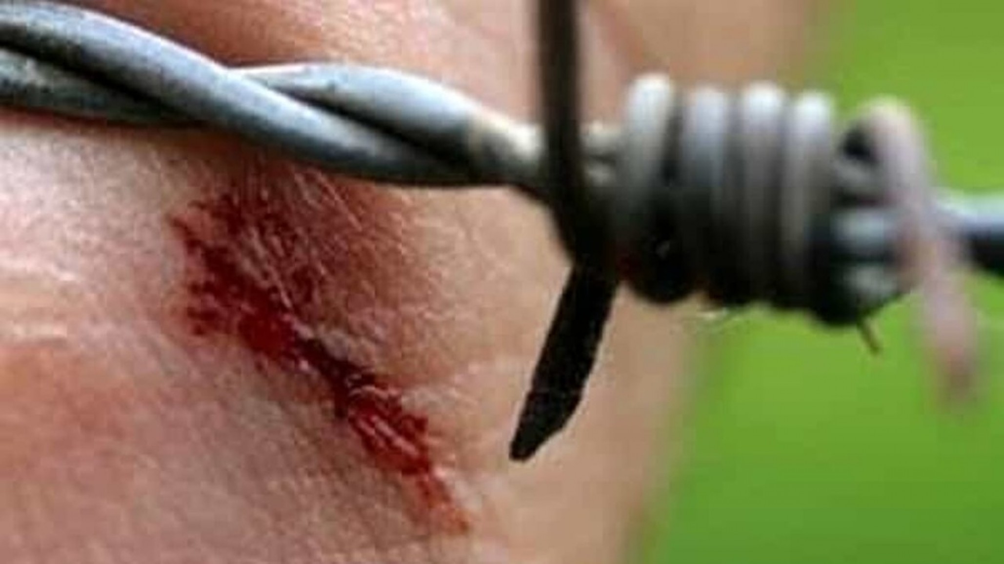 Alerta en Santa Fe: una nena de 5 años está en terapia intensiva por un caso de tétanos