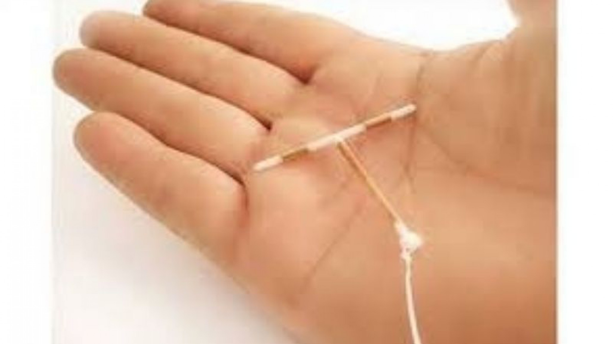 La foto de un recién nacido con el DIU en la cabeza, que se volvió viral