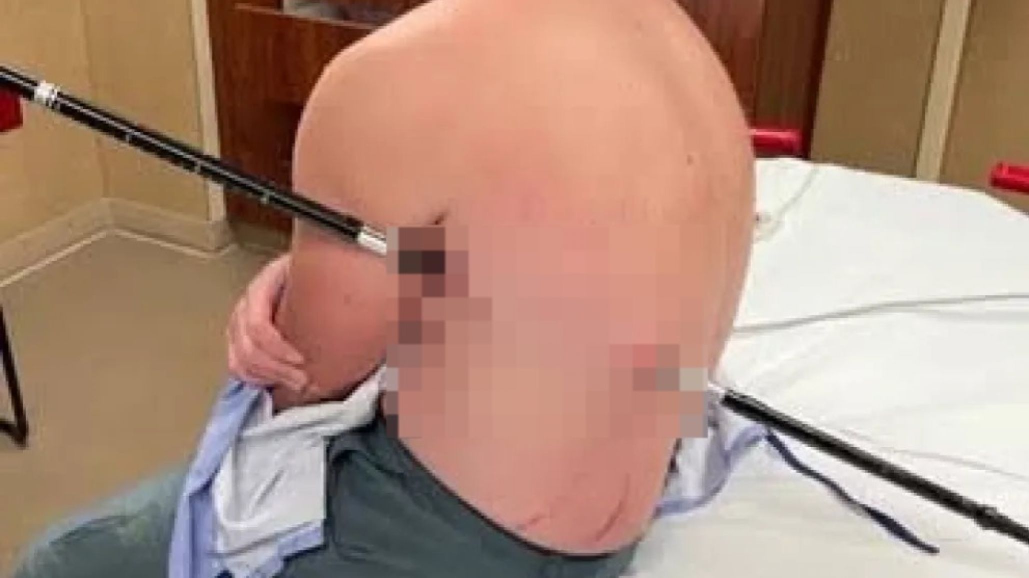 Se empaló con un bastón mientras escalaba una montaña y caminó 16 kilómetros para salvar su vida