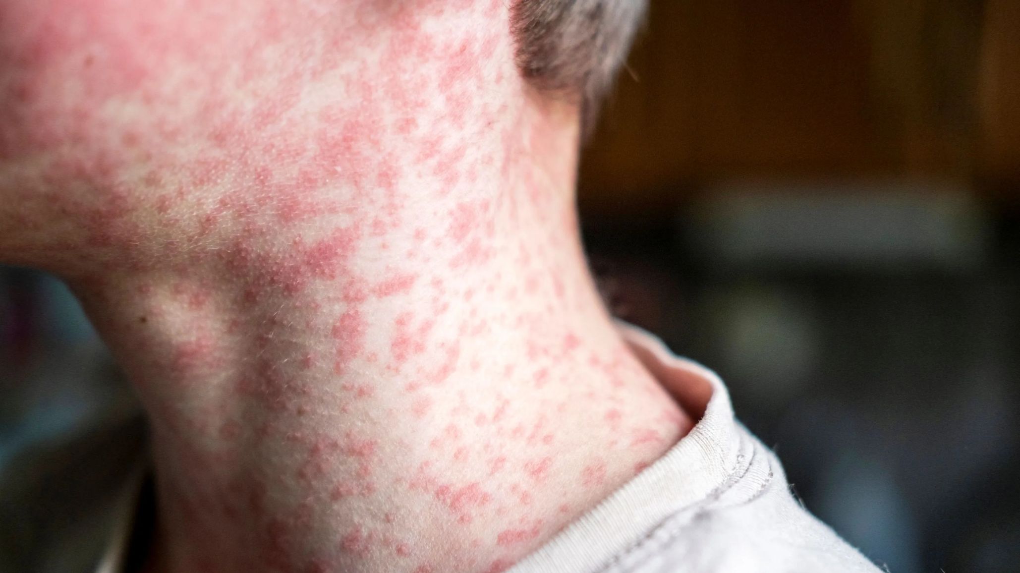 Alerta sanitaria por sarampión: advierten por el riesgo de reintroducción del virus y explican qué factores impulsan los contagios