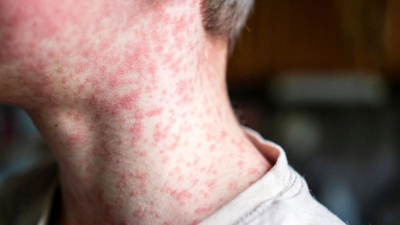 Alerta sanitaria por sarampión: advierten por el riesgo de reintroducción del virus y explican qué factores impulsan los contagios